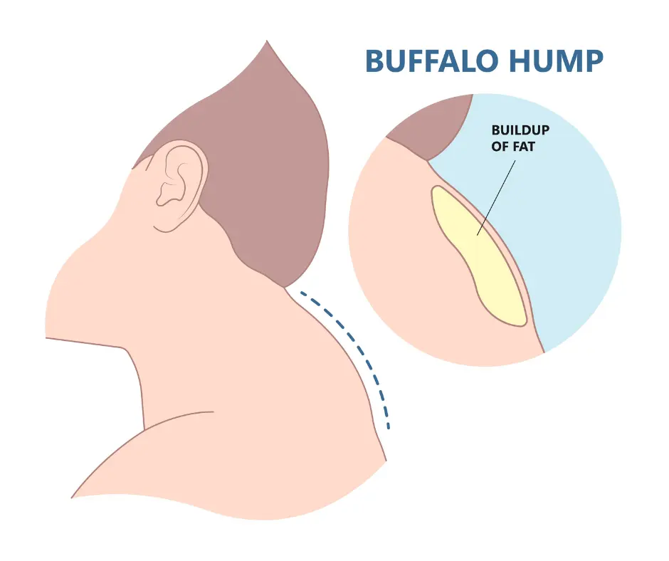Buffalo hump on a man's neck, characterized by a prominent hump formation.