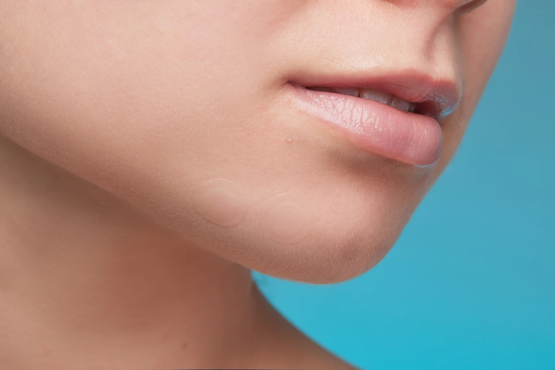 A close up of a woman's face with an exceptionally defined chin after undergoing chin Liposuction.