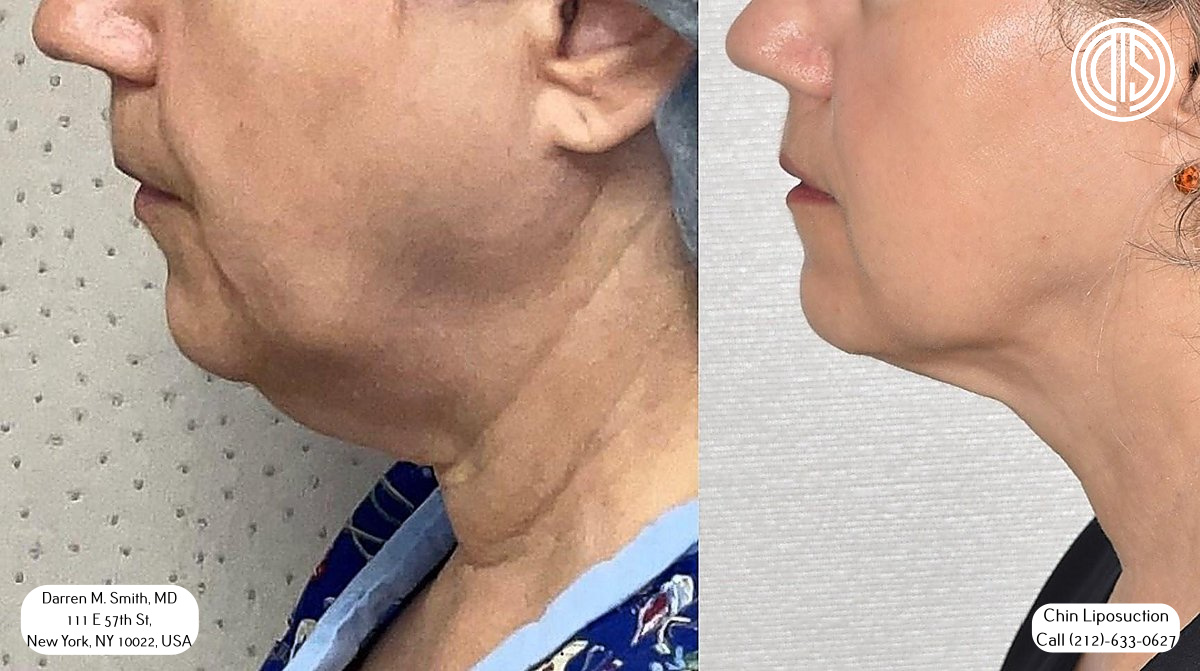 A woman's chin before and after chin liposuction.