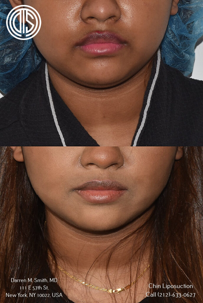 A woman's face before and after chin liposuction.