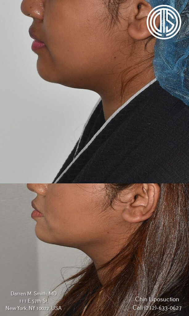 A woman's chin before and after chin and jowl liposuction, achieving her desired dream jawline.