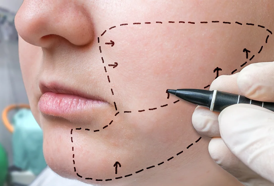 A woman's face is being outlined with a marker, for chin liposuction procedure.
