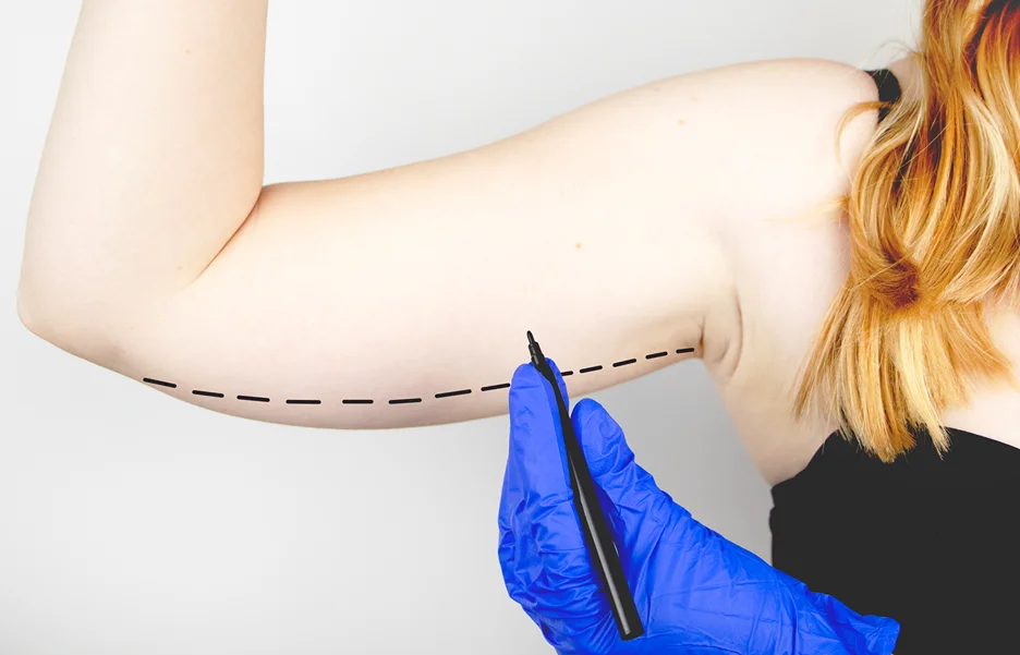 A woman undergoing arm liposuction.