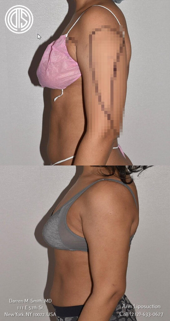 Arm liposuction before and after.