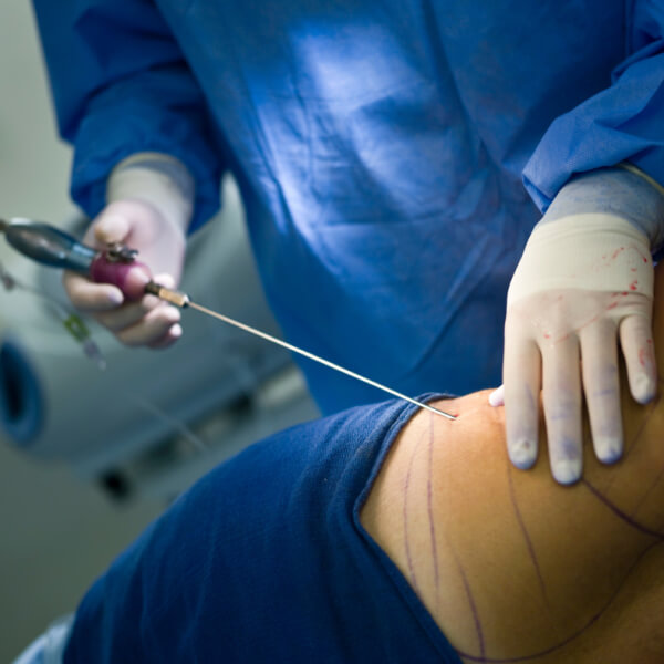 A surgeon is performing surgery on a patient to address their love handles.