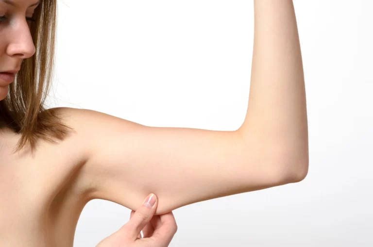 A woman is pointing her arm, showcasing the results of brachioplasty surgery.
