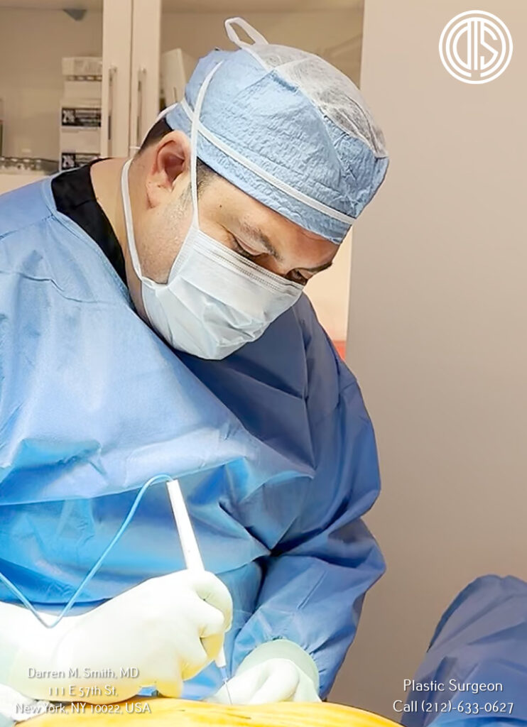 A surgeon is performing non-invasive arm lipo to sculpt the patient's arms.