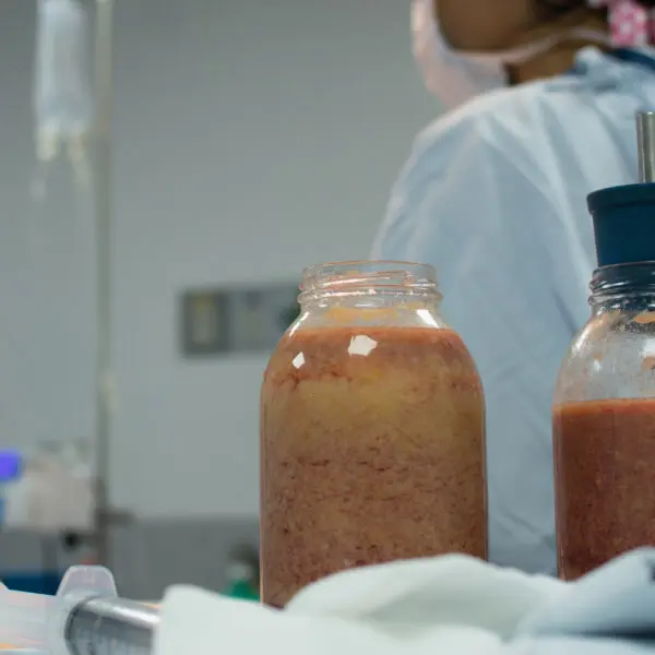 Two jars filled with stomach liquid on a table in an operating room.