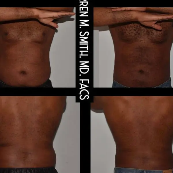 Stomach tuck before and after pictures.