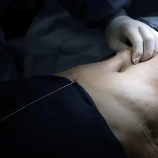 A man is undergoing stomach surgery.