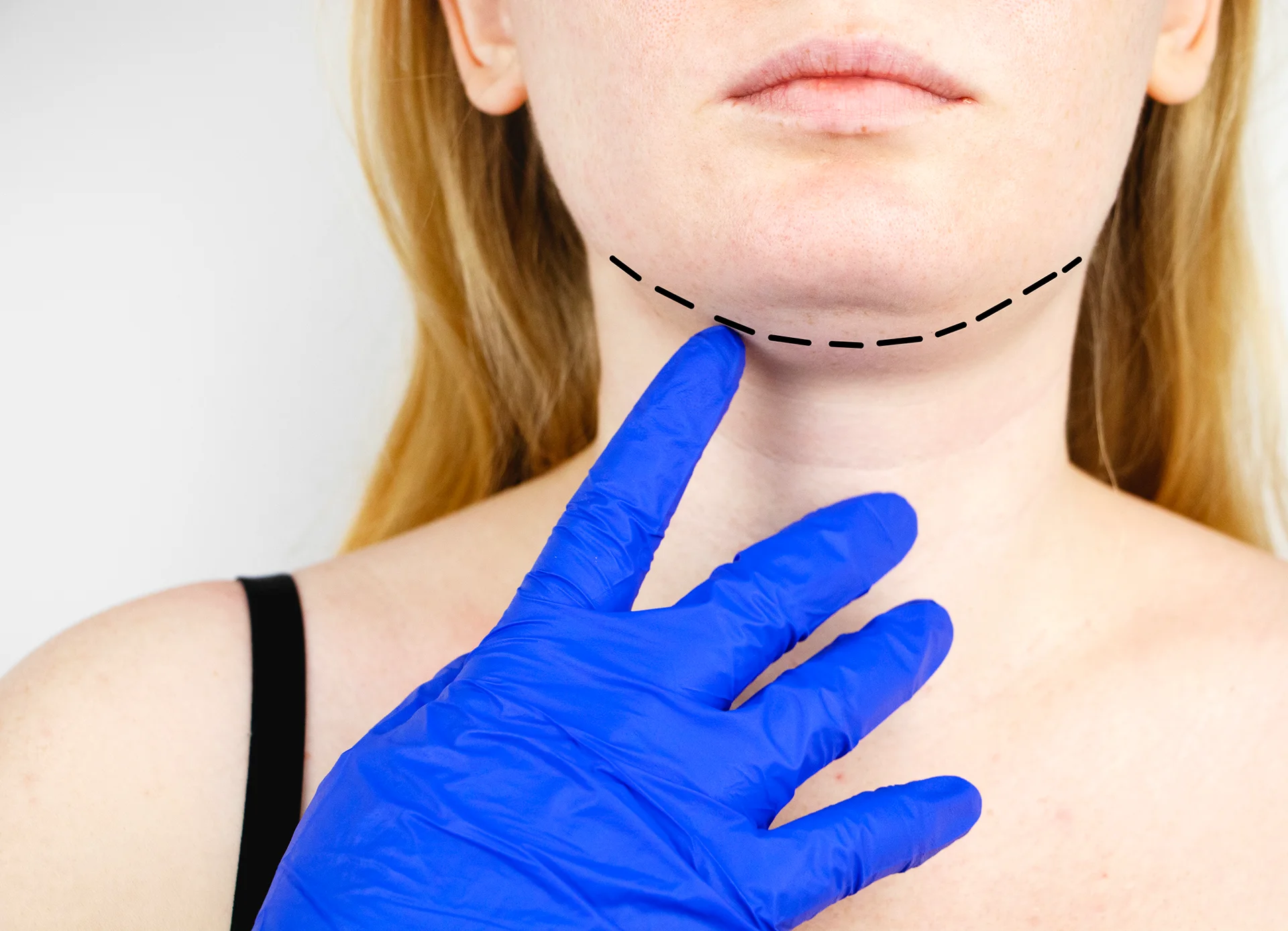 A woman with a swollen lymph nodes on her neck after chin liposuction.