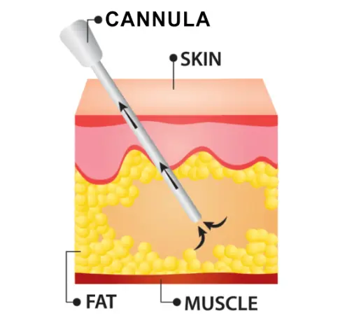 A labeled diagram illustrating the structure of skin with a focus on VASER technology.