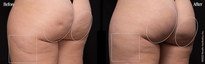Before and after images of a woman's thigh undergoing Aveli cellulite treatment.