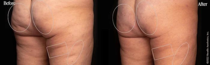 Before and after pictures showcasing the effect of Aveli treatment on a woman's thigh cellulite.