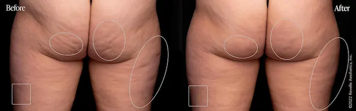 Before and after images of a woman's thighs showcasing Aveli cellulite treatment results.