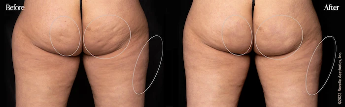 Before and after pictures of a woman's thighs showcasing Aveli cellulite treatment results.