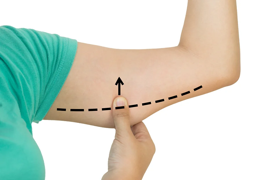 An arrow pointing down on a woman's arm signifies the potential risks of a Brachioplasty procedure.