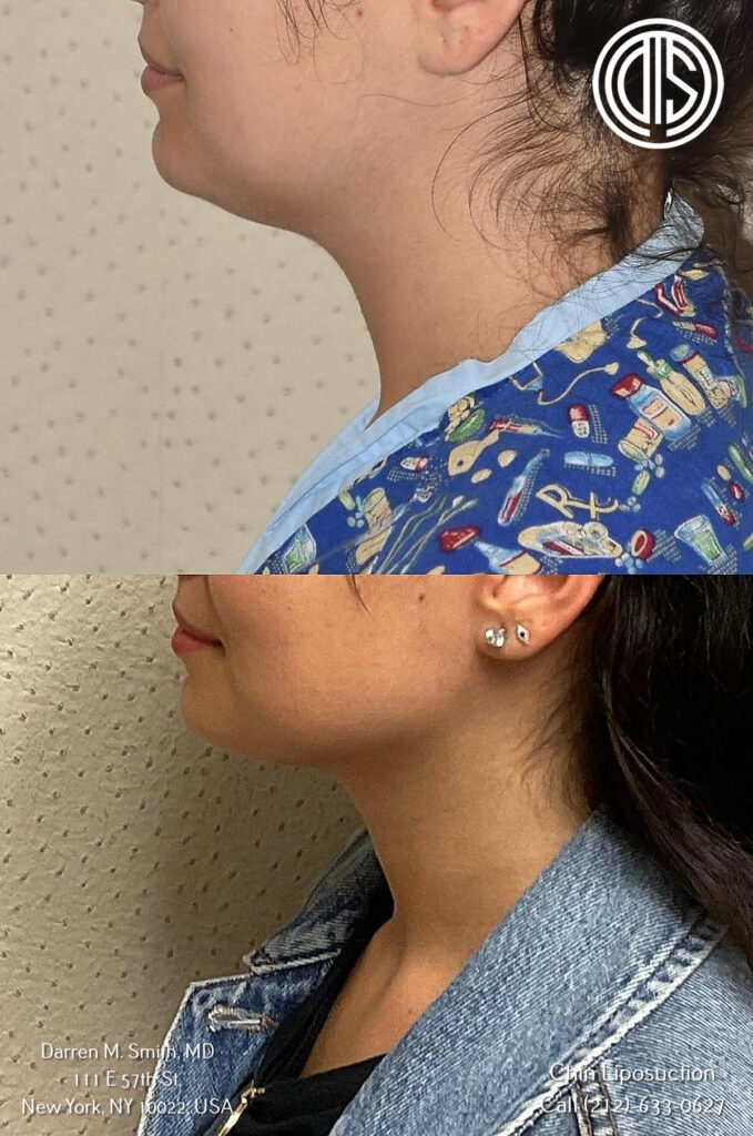 A woman's chin before and after chin liposuction.