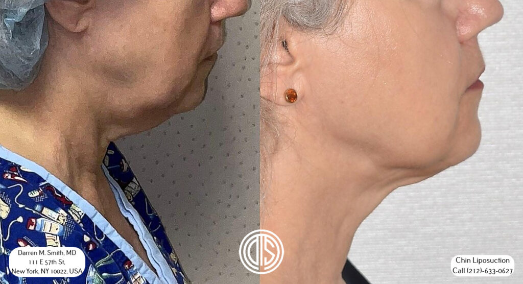A woman's chin before and after non-invasive liposuction treatment for fat reduction.
