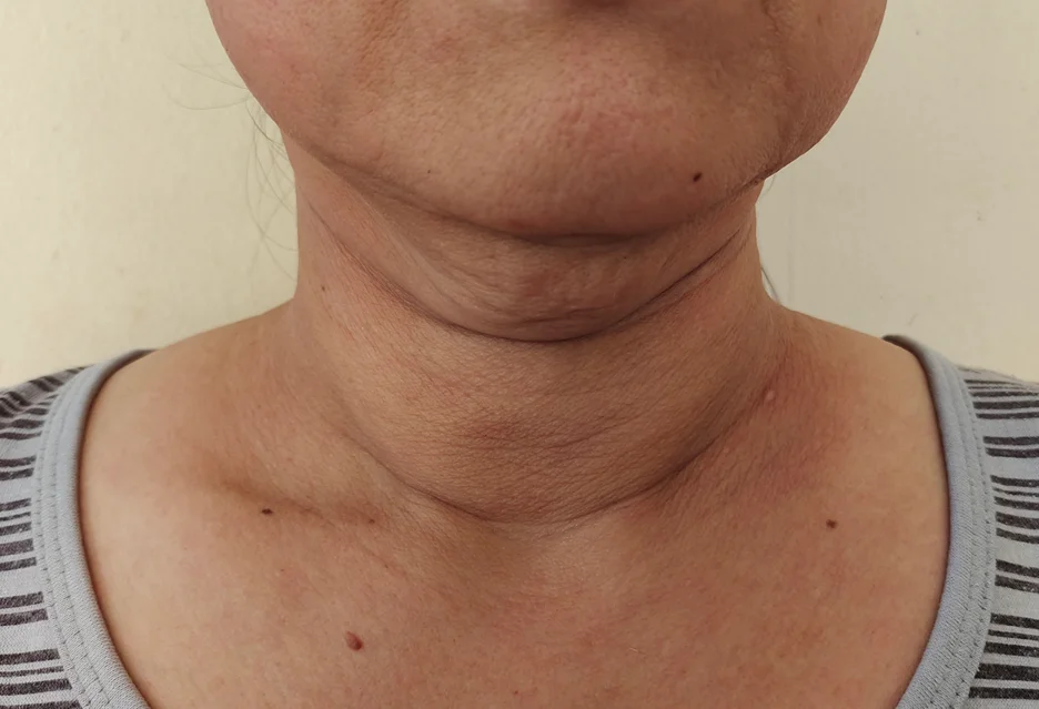 An expert's close-up examination of a woman's neck, recovering from seroma after chin lipo.