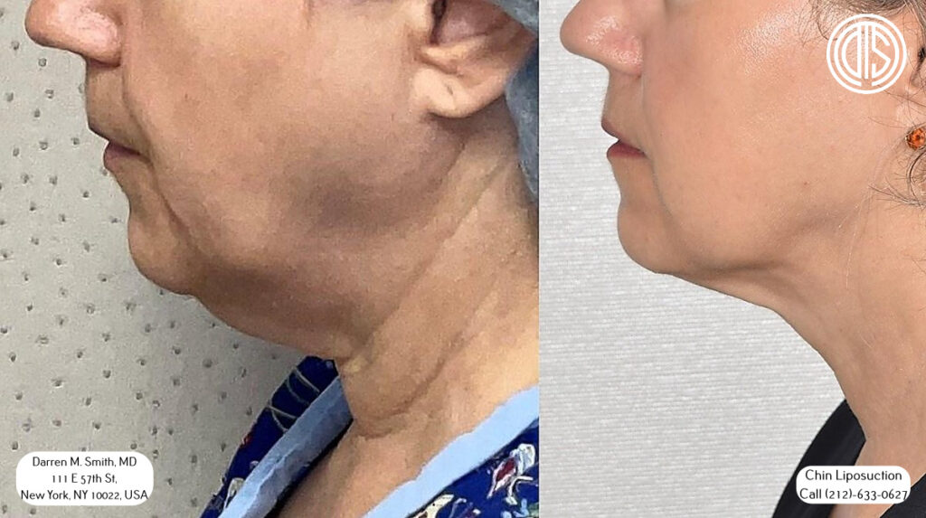 Before and after chin liposuction, a woman's recovering neck shows visible improvement and reduction of seroma.