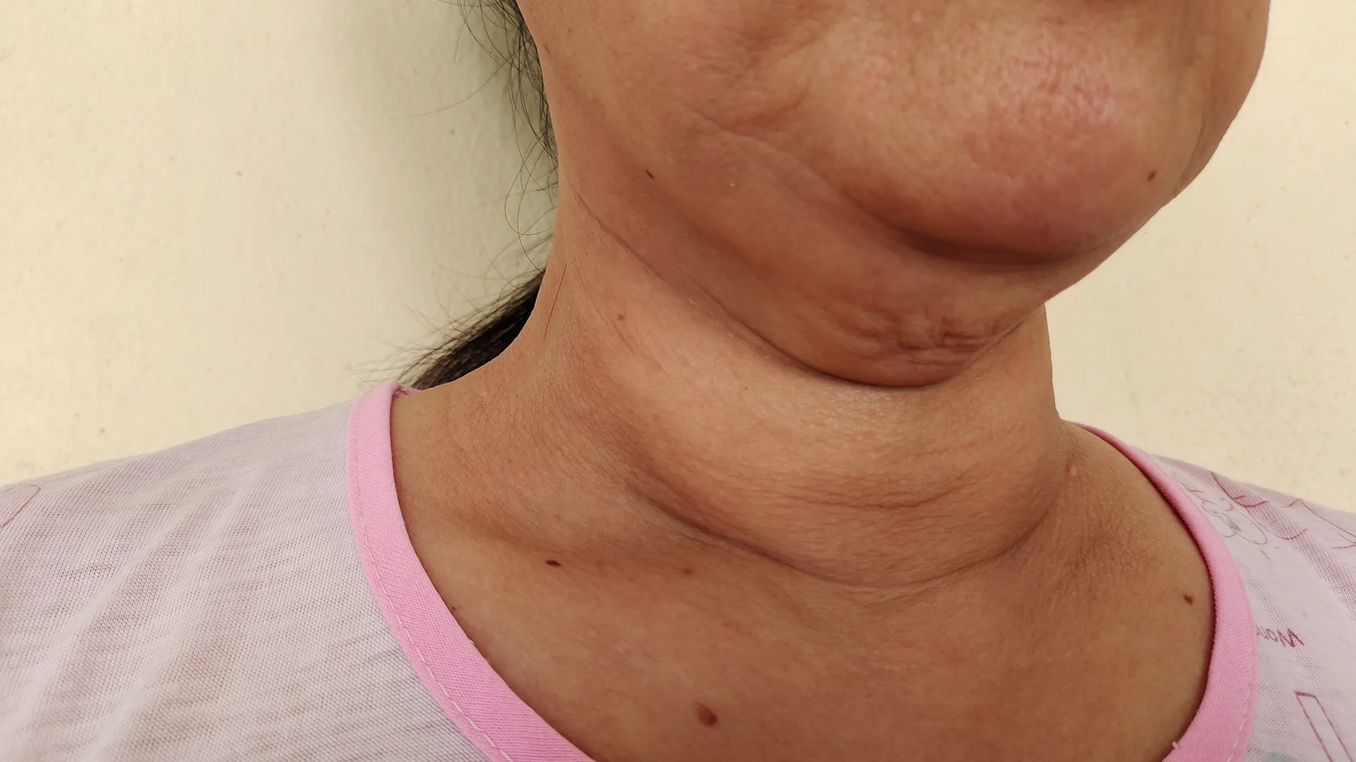 Expert advice on recovering from a seroma, showing a close up of a woman's neck.