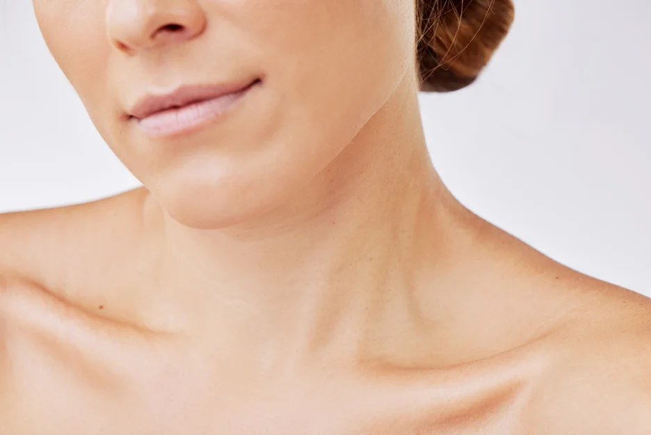 A close up of a woman's neck after undergoing submental chin liposuction.