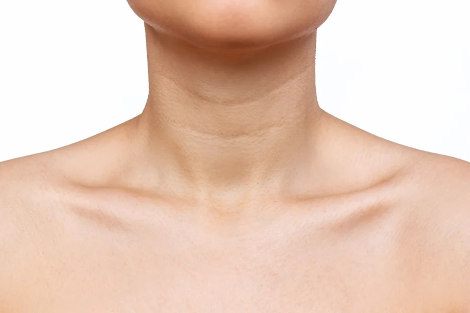 A close up of a woman's neck and chin undergoing submental chin liposuction.
