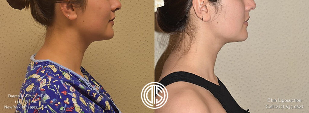 A woman's neck and chin before and after a submental liposuction.