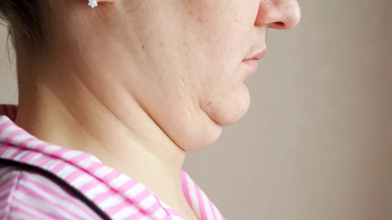 A non-invasive fat reduction treatment on a woman's chin.