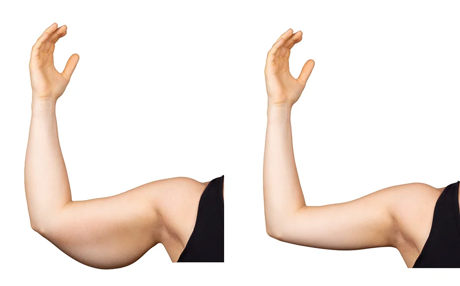 A woman's arm before and after a bilateral brachioplasty.