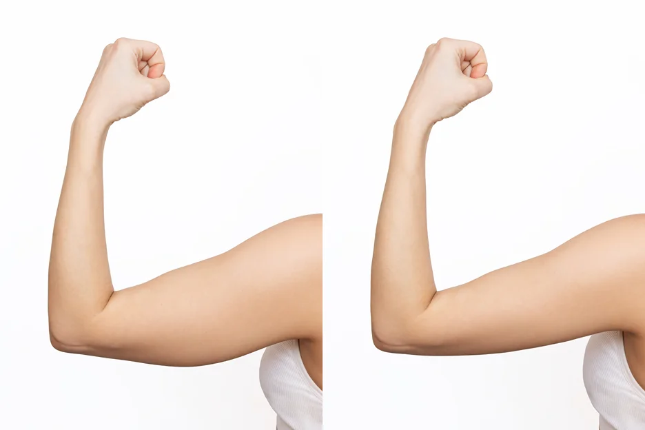 A woman is flexing her arm before and after a Brachioplasty treatment.