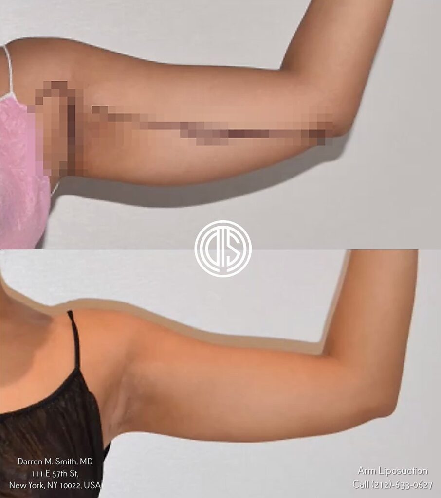 A woman's arm before and after a bilateral brachioplasty procedure.
