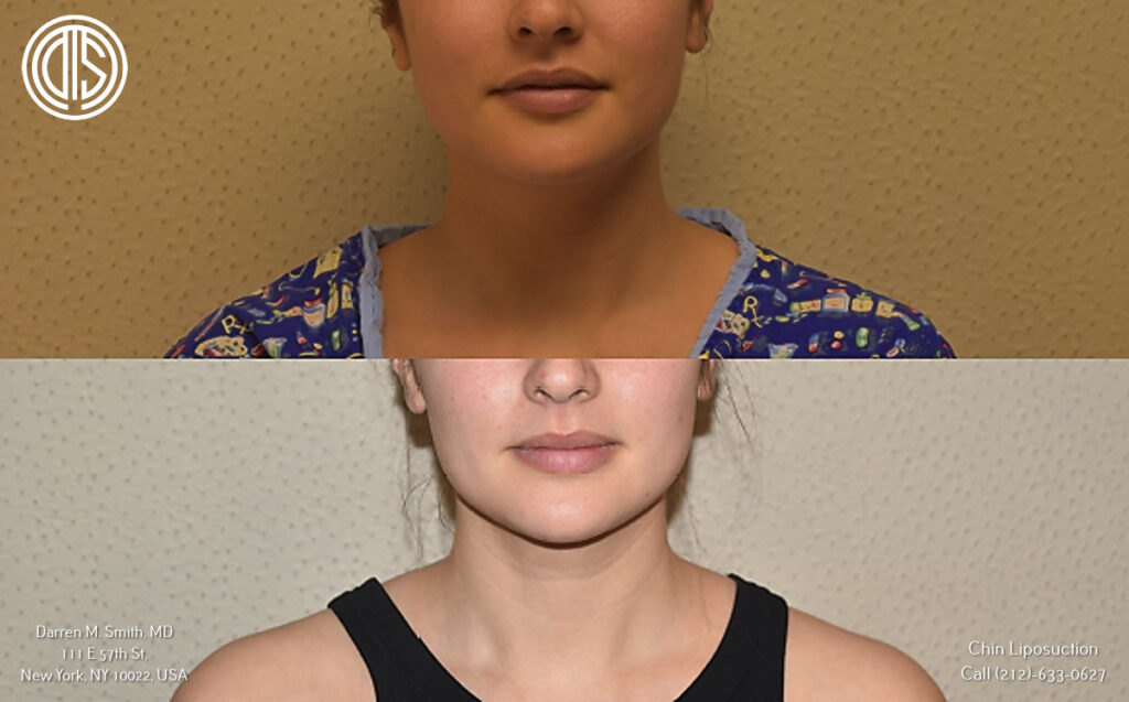 A woman's face before and after chin liposuction.