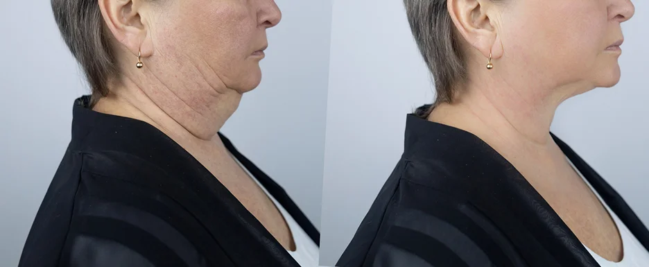 A woman's neck before and after Chin Lipo.