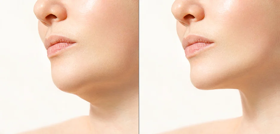 A woman's face before and after chin lipo.
