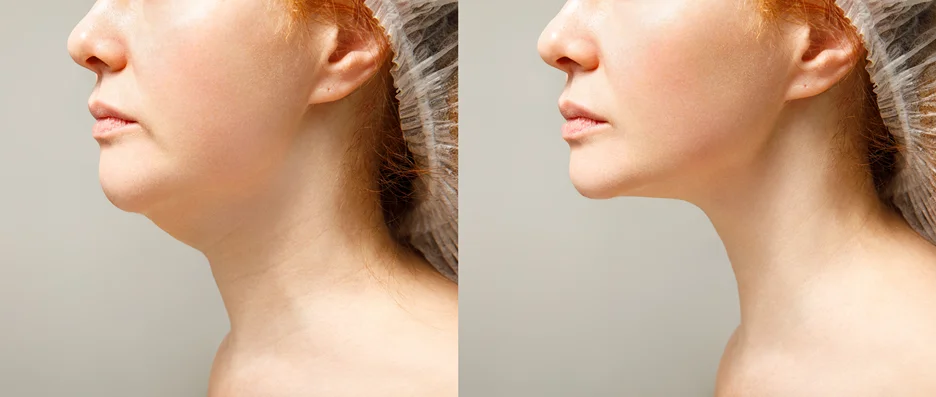 A woman's neck before and after chin liposuction.