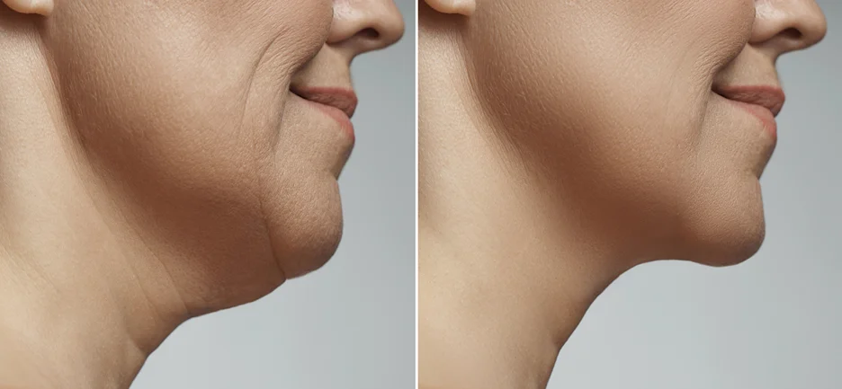 A woman's chin before and after liposuction of a double chin.
