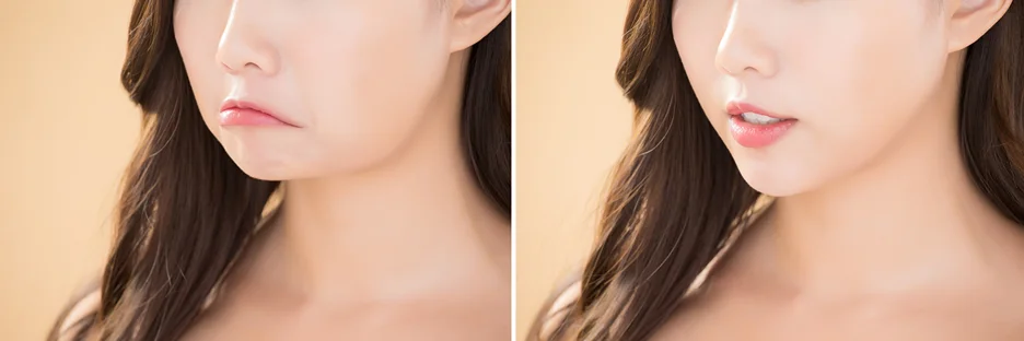 Before and after pictures of a woman's chin, showcasing an aesthetic transformation.