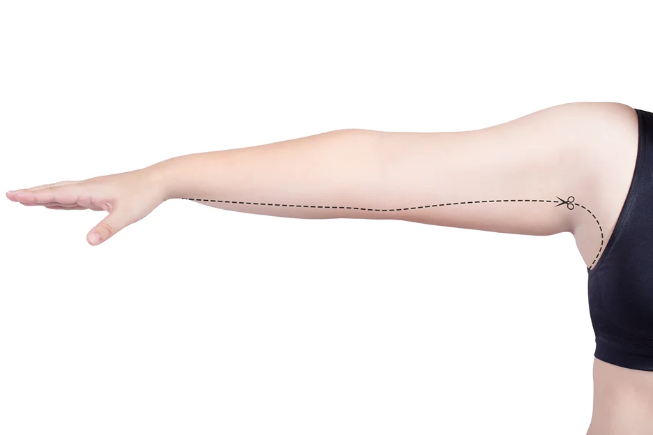 A Woman's Arm preparing for Liposuction