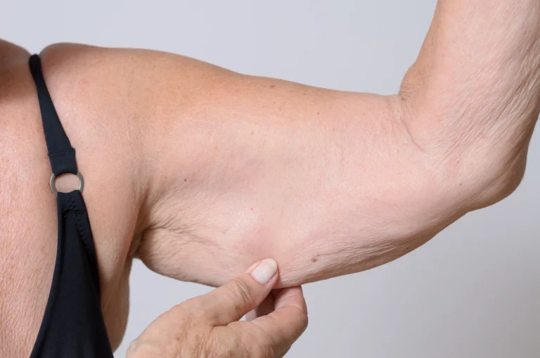 Close-up view of a person pinching the skin on their upper arm, highlighting loose skin or cellulite after arm liposuction.