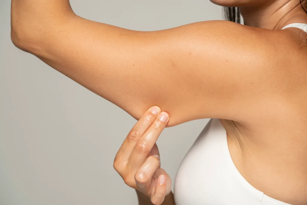 A Woman's Arm before Arm Liposuction