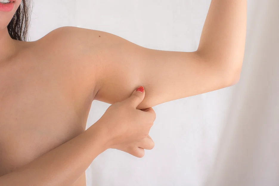A Woman pinching her arm before Liposuction