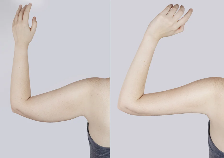 Before and After Lipo Pictures of a Woman's arm