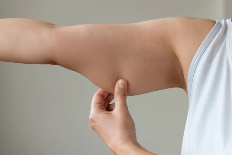 A person pinching the skin on their upper arm, focusing on body fat measurement during arm liposuction recovery.