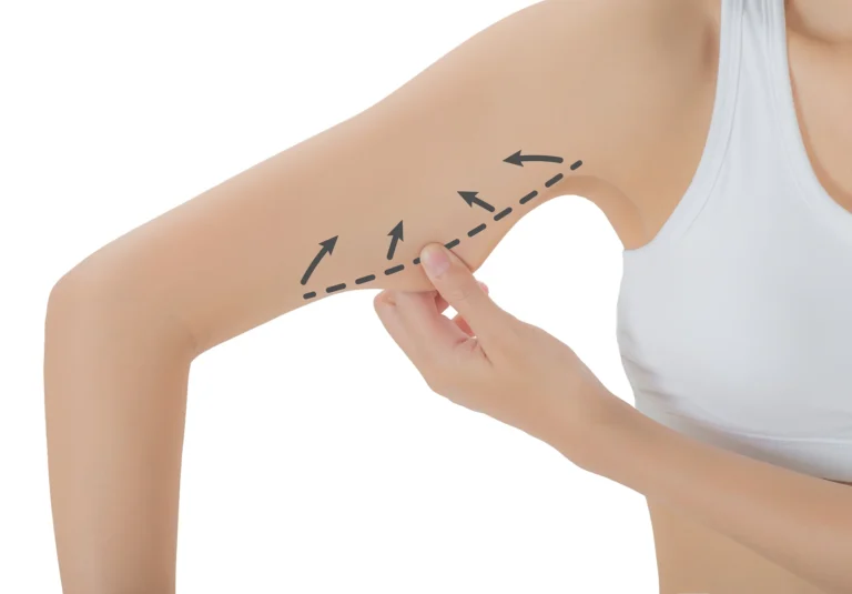 A woman pointing at surgical marks drawn for an arm liposuction procedure, isolated on a white background.