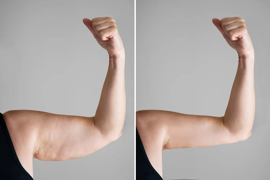 A Woman's Arm Before and After Liposuction