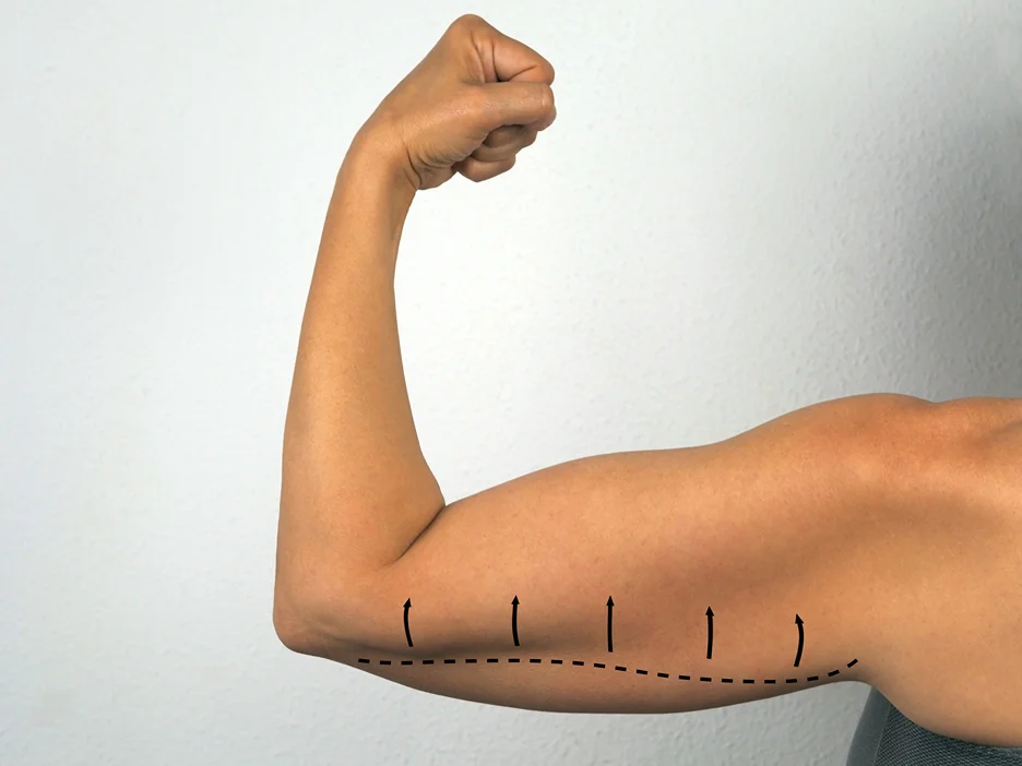 A Woman's Arm Preparing for Arm Liposuction