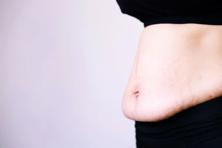 Close-up of a person's midsection showing excess skin on the stomach, with a black shirt lifted slightly, against a light grey background after a Mommy Makeover.