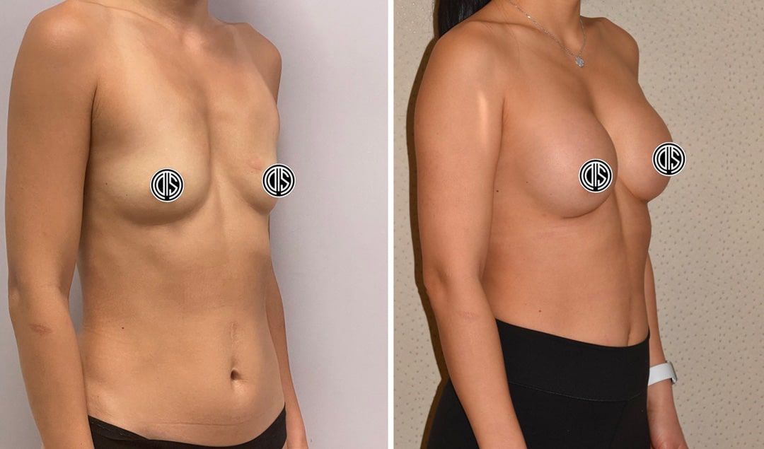 Motiva Implants-4